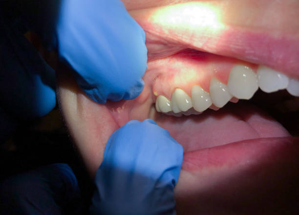 Best Emergency Denture Repair in Villanova, PA